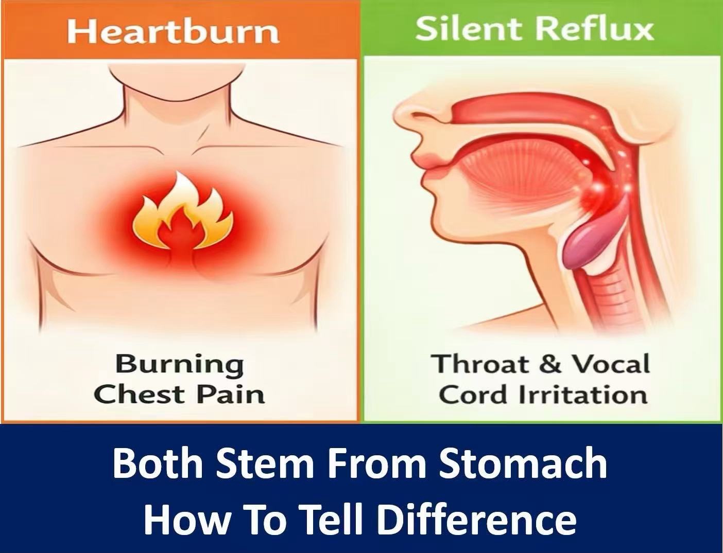 Heartburn vs. Silent Reflux: How to Tell the Difference?